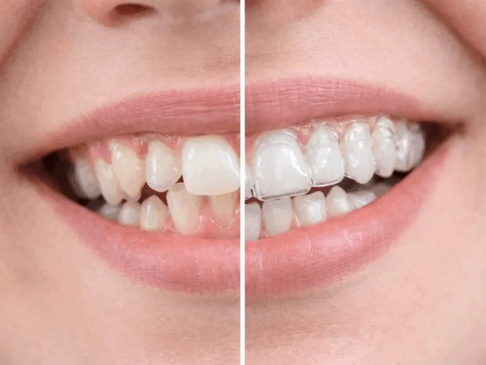 Teeth whitening and clear aligner clinical result
